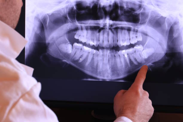 Best Emergency Treatment for Dental Infections or Abscesses in Lake Mack Forest Hills, FL