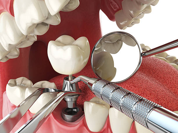 Best Urgent Care for Lost Fillings or Crowns in Lake Mack Forest Hills, FL